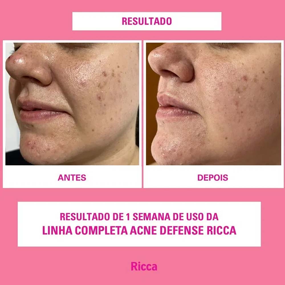 Gel Esfoliante Facial Acne Defense Ricca
