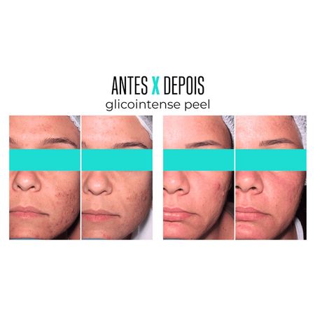 Gel-Creme-Facial-Creamy-Glicointense-Peel-30-g-30-g--4