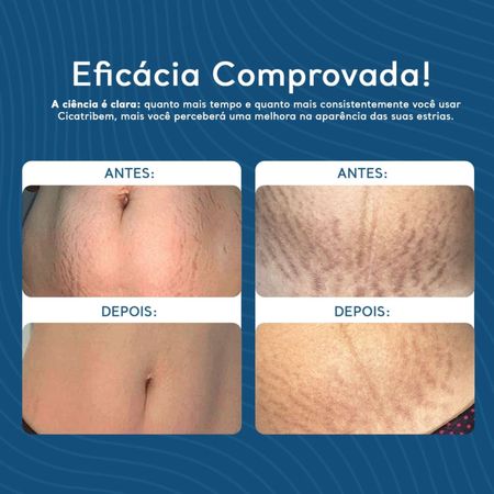 Creme-para-Estrias-Regenerador-Dérmico-Cicatribem-150g---Creme-Hidratante-Antiestrias-150g--10