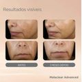 Isdin Sérum Facial Clareador Melaclear Advanced 30ml