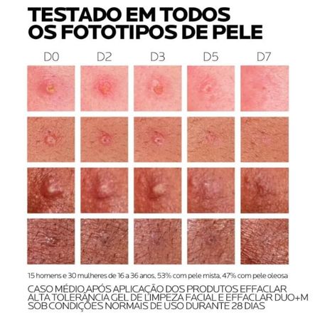 Effaclar-Duo+M-Creme-Antiacne-La-Roche-Posay-40ml--5